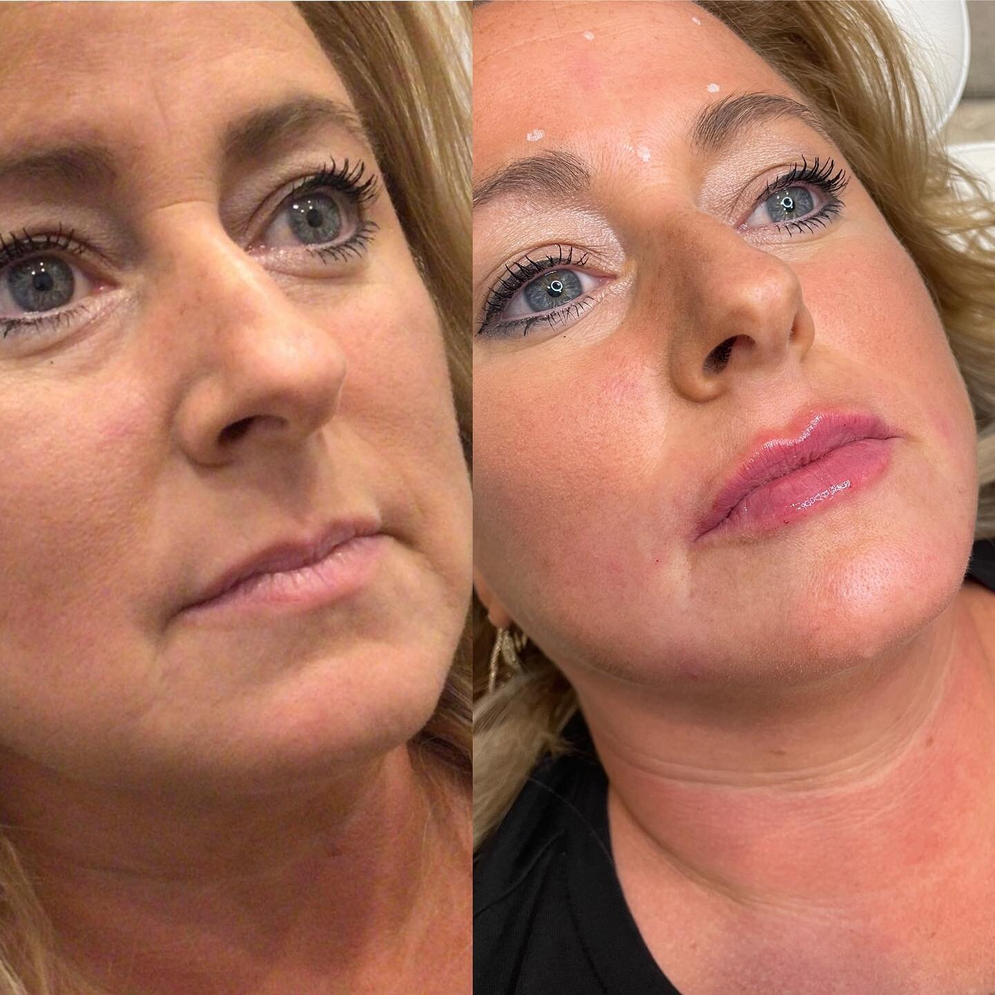 Achieve Youthful Skin: Microneedling PRP Specialists Nearby post thumbnail image