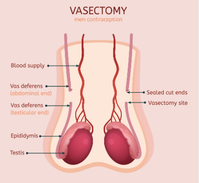 Reversing Sterility: Vasectomy Reversal Procedures in Regina post thumbnail image